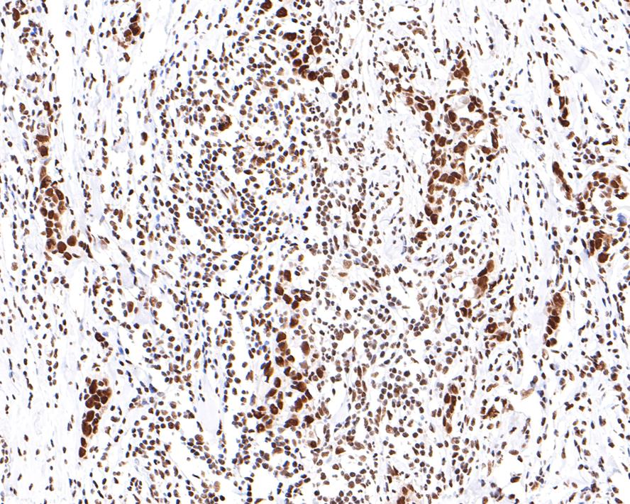 Immunohistochemical analysis of paraffin-embedded human breast carcinoma tissue with Rabbit anti-SMC1 antibody (ET1611-97) at 1/400 dilution.<br />
<br />
The section was pre-treated using heat mediated antigen retrieval with sodium citrate buffer (pH 6.0) for 2 minutes. The tissues were blocked in 1% BSA for 20 minutes at room temperature, washed with ddH2O and PBS, and then probed with the primary antibody (ET1611-97) at 1/400 dilution for 1 hour at room temperature. The detection was performed using an HRP conjugated compact polymer system. DAB was used as the chromogen. Tissues were counterstained with hematoxylin and mounted with DPX.