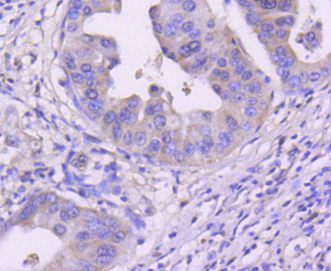 Immunohistochemical analysis of paraffin-embedded human stomach carcinoma tissue using anti-Cdk4 antibody. The section was pre-treated using heat mediated antigen retrieval with Tris-EDTA buffer (pH 8.0-8.4) for 20 minutes.The tissues were blocked in 5% BSA for 30 minutes at room temperature, washed with ddH2O and PBS, and then probed with the primary antibody (ET1612-1, 1/50) for 30 minutes at room temperature. The detection was performed using an HRP conjugated compact polymer system. DAB was used as the chromogen. Tissues were counterstained with hematoxylin and mounted with DPX.