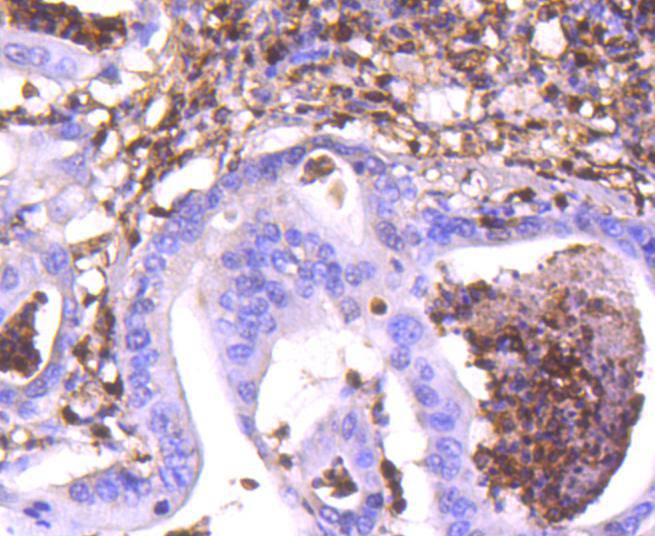 Immunohistochemical analysis of paraffin-embedded human stomach carcinoma tissue using anti-S100A4 antibody. The section was pre-treated using heat mediated antigen retrieval with Tris-EDTA buffer (pH 9.0) for 20 minutes.The tissues were blocked in 1% BSA for 30 minutes at room temperature, washed with ddH2O and PBS, and then probed with the primary antibody (ET1612-13, 1/50) for 30 minutes at room temperature. The detection was performed using an HRP conjugated compact polymer system. DAB was used as the chromogen. Tissues were counterstained with hematoxylin and mounted with DPX.