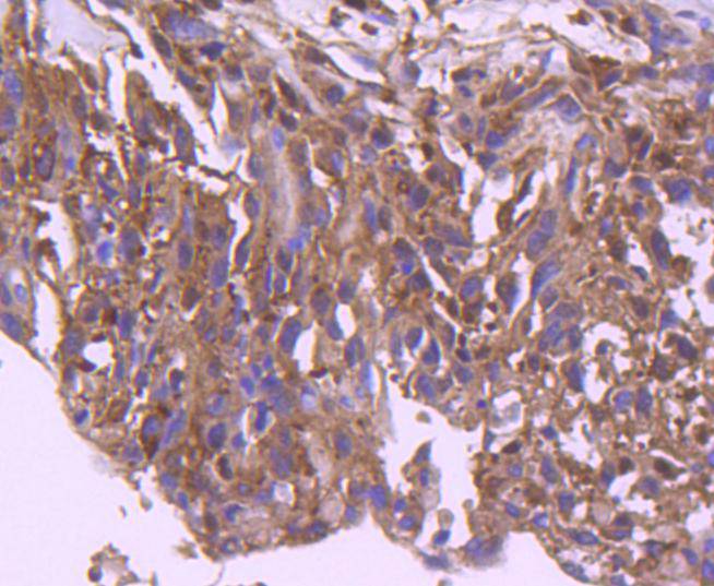 Immunohistochemical analysis of paraffin-embedded human breast carcinoma tissue using anti-IRF3 antibody. The section was pre-treated using heat mediated antigen retrieval with Tris-EDTA buffer (pH 8.0-8.4) for 20 minutes.The tissues were blocked in 5% BSA for 30 minutes at room temperature, washed with ddH2O and PBS, and then probed with the primary antibody (ET1612-14, 1/50) for 30 minutes at room temperature. The detection was performed using an HRP conjugated compact polymer system. DAB was used as the chromogen. Tissues were counterstained with hematoxylin and mounted with DPX.