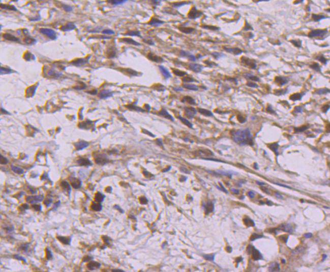 Immunohistochemical analysis of paraffin-embedded human breast carcinoma tissue using anti-Cyclin E2 antibody. The section was pre-treated using heat mediated antigen retrieval with Tris-EDTA buffer (pH 8.0-8.4) for 20 minutes.The tissues were blocked in 5% BSA for 30 minutes at room temperature, washed with ddH2O and PBS, and then probed with the primary antibody (ET1612-17, 1/50) for 30 minutes at room temperature. The detection was performed using an HRP conjugated compact polymer system. DAB was used as the chromogen. Tissues were counterstained with hematoxylin and mounted with DPX.