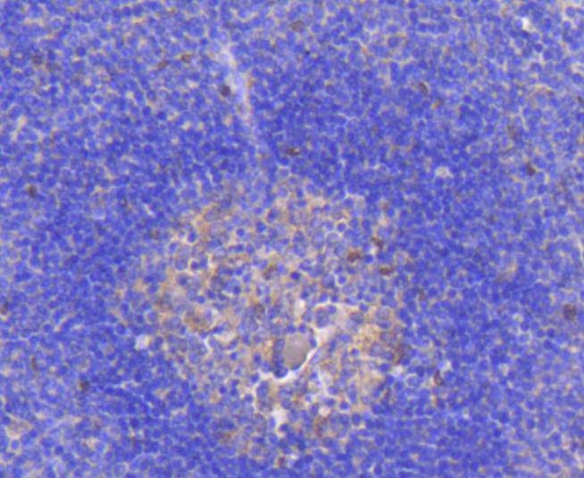 Immunohistochemical analysis of paraffin-embedded human breast carcinoma tissue using anti-RelB antibody. The section was pre-treated using heat mediated antigen retrieval with Tris-EDTA buffer (pH 8.0-8.4) for 20 minutes.The tissues were blocked in 5% BSA for 30 minutes at room temperature, washed with ddH2O and PBS, and then probed with the primary antibody (ET1612-18, 1/50) for 30 minutes at room temperature. The detection was performed using an HRP conjugated compact polymer system. DAB was used as the chromogen. Tissues were counterstained with hematoxylin and mounted with DPX.