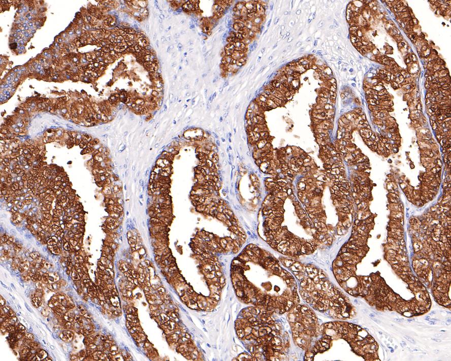 Immunohistochemical analysis of paraffin-embedded human prostate tissue with Rabbit anti-Prostate Specific Antigen antibody (ET1612-19) at 1/1,000 dilution.<br />
<br />
The section was pre-treated using heat mediated antigen retrieval with Tris-EDTA buffer (pH 9.0) for 20 minutes. The tissues were blocked in 1% BSA for 20 minutes at room temperature, washed with ddH2O and PBS, and then probed with the primary antibody (ET1612-19) at 1/1,000 dilution for 1 hour at room temperature. The detection was performed using an HRP conjugated compact polymer system. DAB was used as the chromogen. Tissues were counterstained with hematoxylin and mounted with DPX.