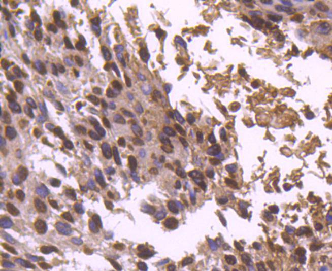 Immunohistochemical analysis of paraffin-embedded human breast carcinoma tissue using anti-Histone H2B antibody. The section was pre-treated using heat mediated antigen retrieval with Tris-EDTA buffer (pH 8.0-8.4) for 20 minutes.The tissues were blocked in 5% BSA for 30 minutes at room temperature, washed with ddH2O and PBS, and then probed with the primary antibody (ET1612-25, 1/50) for 30 minutes at room temperature. The detection was performed using an HRP conjugated compact polymer system. DAB was used as the chromogen. Tissues were counterstained with hematoxylin and mounted with DPX.
