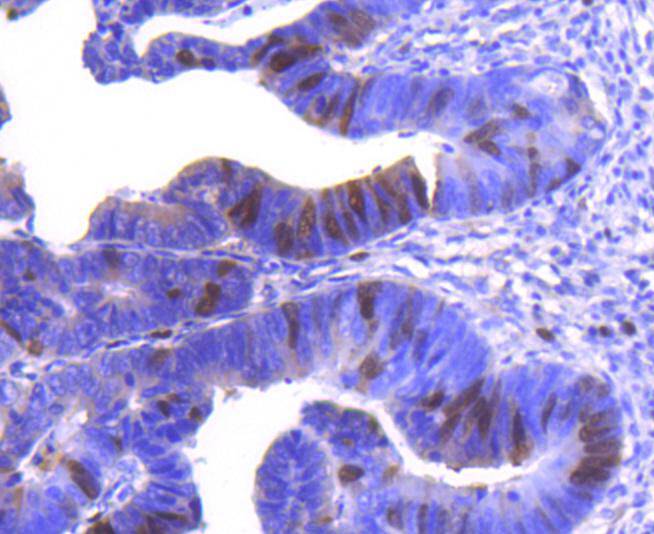 Immunohistochemical analysis of paraffin-embedded human colon carcinoma tissue using anti-Cyclin A2 antibody. The section was pre-treated using heat mediated antigen retrieval with Tris-EDTA buffer (pH 8.0-8.4) for 20 minutes.The tissues were blocked in 5% BSA for 30 minutes at room temperature, washed with ddH2O and PBS, and then probed with the primary antibody (ET1612-26, 1/50) for 30 minutes at room temperature. The detection was performed using an HRP conjugated compact polymer system. DAB was used as the chromogen. Tissues were counterstained with hematoxylin and mounted with DPX.
