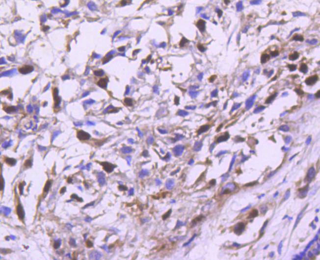 Immunohistochemical analysis of paraffin-embedded human breast carcinoma tissue using anti-Cyclin A2 antibody. The section was pre-treated using heat mediated antigen retrieval with Tris-EDTA buffer (pH 8.0-8.4) for 20 minutes.The tissues were blocked in 5% BSA for 30 minutes at room temperature, washed with ddH2O and PBS, and then probed with the primary antibody (ET1612-26, 1/50) for 30 minutes at room temperature. The detection was performed using an HRP conjugated compact polymer system. DAB was used as the chromogen. Tissues were counterstained with hematoxylin and mounted with DPX.