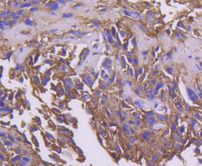 Immunohistochemical analysis of paraffin-embedded human breast carcinoma tissue using anti-PDPK1 antibody. The section was pre-treated using heat mediated antigen retrieval with Tris-EDTA buffer (pH 8.0-8.4) for 20 minutes.The tissues were blocked in 5% BSA for 30 minutes at room temperature, washed with ddH2O and PBS, and then probed with the primary antibody (ET1612-27, 1/50) for 30 minutes at room temperature. The detection was performed using an HRP conjugated compact polymer system. DAB was used as the chromogen. Tissues were counterstained with hematoxylin and mounted with DPX.