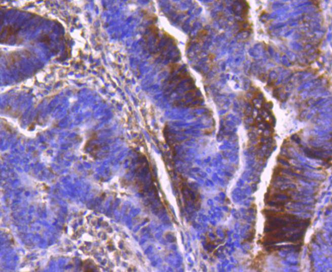 Immunohistochemical analysis of paraffin-embedded human colon carcinoma tissue using anti-PDPK1 antibody. The section was pre-treated using heat mediated antigen retrieval with Tris-EDTA buffer (pH 8.0-8.4) for 20 minutes.The tissues were blocked in 5% BSA for 30 minutes at room temperature, washed with ddH2O and PBS, and then probed with the primary antibody (ET1612-27, 1/50) for 30 minutes at room temperature. The detection was performed using an HRP conjugated compact polymer system. DAB was used as the chromogen. Tissues were counterstained with hematoxylin and mounted with DPX.