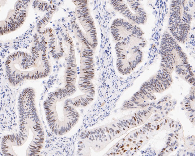 Immunohistochemical analysis of paraffin-embedded human colon carcinoma tissue using anti-Phospho-Cyclin E1(T77) antibody. The section was pre-treated using heat mediated antigen retrieval with sodium citrate buffer (pH 6.0) for 20 minutes. The tissues were blocked in 5% BSA for 30 minutes at room temperature, washed with ddH2O and PBS, and then probed with the primary antibody (ET1612-31, 1/50)  for 30 minutes at room temperature. The detection was performed using an HRP conjugated compact polymer system. DAB was used as the chromogen. Tissues were counterstained with hematoxylin and mounted with DPX.