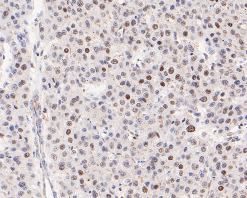 Immunohistochemical analysis of paraffin-embedded human liver carcinoma tissue using anti-ATF4 antibody. The section was pre-treated using heat mediated antigen retrieval with sodium citrate buffer (pH 6.0) for 20 minutes. The tissues were blocked in 5% BSA for 30 minutes at room temperature, washed with ddH2O and PBS, and then probed with the primary antibody (ET1612-37, 1/50)  for 30 minutes at room temperature. The detection was performed using an HRP conjugated compact polymer system. DAB was used as the chromogen. Tissues were counterstained with hematoxylin and mounted with DPX.