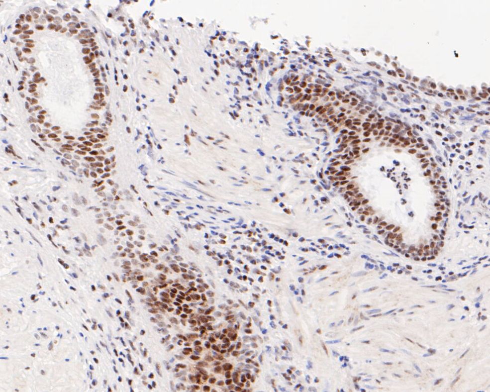 Immunohistochemical analysis of paraffin-embedded human prostate carcinoma tissue using anti-ATF4 antibody. The section was pre-treated using heat mediated antigen retrieval with sodium citrate buffer (pH 6.0) for 20 minutes. The tissues were blocked in 5% BSA for 30 minutes at room temperature, washed with ddH2O and PBS, and then probed with the primary antibody (ET1612-37, 1/50)  for 30 minutes at room temperature. The detection was performed using an HRP conjugated compact polymer system. DAB was used as the chromogen. Tissues were counterstained with hematoxylin and mounted with DPX.
