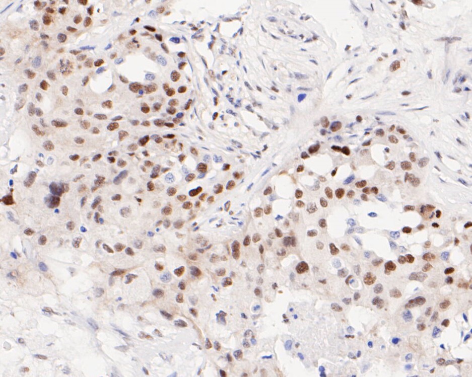 Immunohistochemical analysis of paraffin-embedded human breast carcinoma tissue using anti-ATF4 antibody. The section was pre-treated using heat mediated antigen retrieval with sodium citrate buffer (pH 6.0) for 20 minutes. The tissues were blocked in 5% BSA for 30 minutes at room temperature, washed with ddH2O and PBS, and then probed with the primary antibody (ET1612-37, 1/50)  for 30 minutes at room temperature. The detection was performed using an HRP conjugated compact polymer system. DAB was used as the chromogen. Tissues were counterstained with hematoxylin and mounted with DPX.