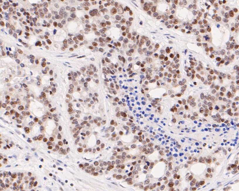 Immunohistochemical analysis of paraffin-embedded human stomach carcinoma tissue using anti-ATF4 antibody. The section was pre-treated using heat mediated antigen retrieval with sodium citrate buffer (pH 6.0) for 20 minutes. The tissues were blocked in 5% BSA for 30 minutes at room temperature, washed with ddH2O and PBS, and then probed with the primary antibody (ET1612-37, 1/50)  for 30 minutes at room temperature. The detection was performed using an HRP conjugated compact polymer system. DAB was used as the chromogen. Tissues were counterstained with hematoxylin and mounted with DPX.