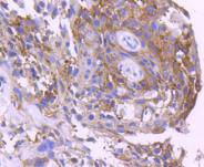 Immunohistochemical analysis of paraffin-embedded human breast carcinoma tissue using anti-14-3-3 sigma antibody. The section was pre-treated using heat mediated antigen retrieval with Tris-EDTA buffer (pH 8.0-8.4) for 20 minutes.The tissues were blocked in 5% BSA for 30 minutes at room temperature, washed with ddH2O and PBS, and then probed with the primary antibody (ET1612-41, 1/50) for 30 minutes at room temperature. The detection was performed using an HRP conjugated compact polymer system. DAB was used as the chromogen. Tissues were counterstained with hematoxylin and mounted with DPX.