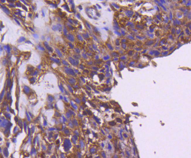 Immunohistochemical analysis of paraffin-embedded human breast carcinoma tissue using anti-IRS1 antibody. The section was pre-treated using heat mediated antigen retrieval with Tris-EDTA buffer (pH 8.0-8.4) for 20 minutes.The tissues were blocked in 5% BSA for 30 minutes at room temperature, washed with ddH2O and PBS, and then probed with the primary antibody (ET1612-45, 1/50) for 30 minutes at room temperature. The detection was performed using an HRP conjugated compact polymer system. DAB was used as the chromogen. Tissues were counterstained with hematoxylin and mounted with DPX.