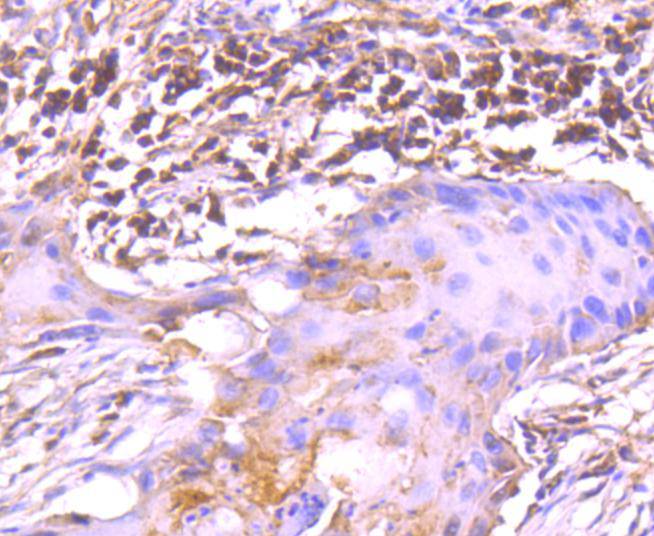 Immunohistochemical analysis of paraffin-embedded human lung carcinoma tissue using anti-TRK fused gene antibody. The section was pre-treated using heat mediated antigen retrieval with Tris-EDTA buffer (pH 8.0-8.4) for 20 minutes.The tissues were blocked in 5% BSA for 30 minutes at room temperature, washed with ddH2O and PBS, and then probed with the primary antibody (ET1612-52, 1/50) for 30 minutes at room temperature. The detection was performed using an HRP conjugated compact polymer system. DAB was used as the chromogen. Tissues were counterstained with hematoxylin and mounted with DPX.