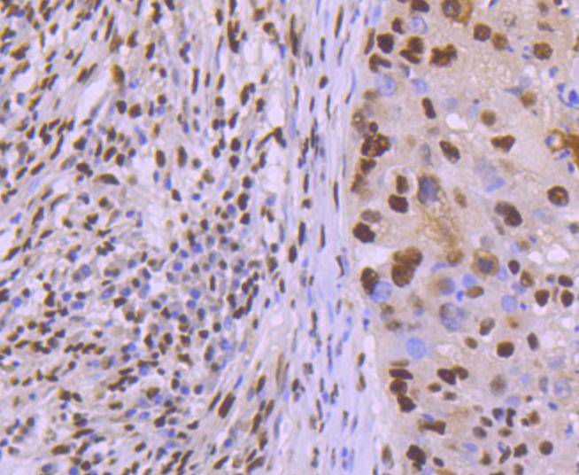 Immunohistochemical analysis of paraffin-embedded human lung carcinoma tissue using anti-KAP1 antibody. The section was pre-treated using heat mediated antigen retrieval with Tris-EDTA buffer (pH 8.0-8.4) for 20 minutes.The tissues were blocked in 5% BSA for 30 minutes at room temperature, washed with ddH2O and PBS, and then probed with the primary antibody (ET1612-55, 1/50) for 30 minutes at room temperature. The detection was performed using an HRP conjugated compact polymer system. DAB was used as the chromogen. Tissues were counterstained with hematoxylin and mounted with DPX.