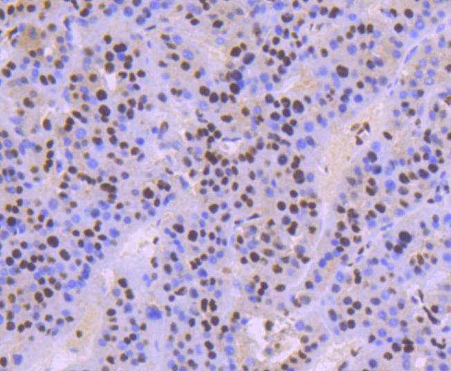 Immunohistochemical analysis of paraffin-embedded human liver carcinoma tissue using anti-KAP1 antibody. The section was pre-treated using heat mediated antigen retrieval with Tris-EDTA buffer (pH 8.0-8.4) for 20 minutes.The tissues were blocked in 5% BSA for 30 minutes at room temperature, washed with ddH2O and PBS, and then probed with the primary antibody (ET1612-55, 1/50) for 30 minutes at room temperature. The detection was performed using an HRP conjugated compact polymer system. DAB was used as the chromogen. Tissues were counterstained with hematoxylin and mounted with DPX.