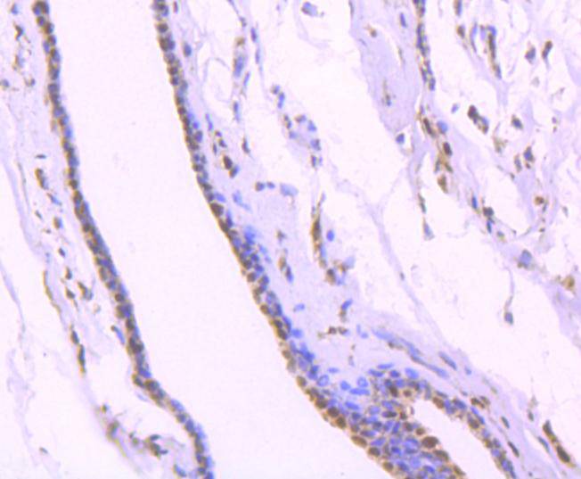 Immunohistochemical analysis of paraffin-embedded human breast carcinoma tissue using anti-KAP1 antibody. The section was pre-treated using heat mediated antigen retrieval with Tris-EDTA buffer (pH 8.0-8.4) for 20 minutes.The tissues were blocked in 5% BSA for 30 minutes at room temperature, washed with ddH2O and PBS, and then probed with the primary antibody (ET1612-55, 1/50) for 30 minutes at room temperature. The detection was performed using an HRP conjugated compact polymer system. DAB was used as the chromogen. Tissues were counterstained with hematoxylin and mounted with DPX.