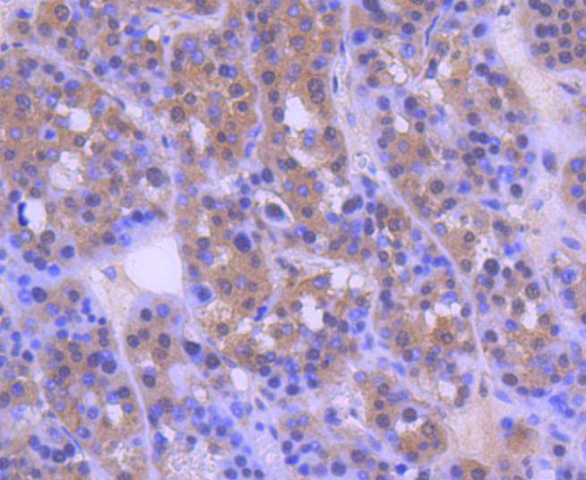Immunohistochemical analysis of paraffin-embedded human liver carcinoma tissue using anti-MEK2 antibody. The section was pre-treated using heat mediated antigen retrieval with Tris-EDTA buffer (pH 9.0) for 20 minutes.The tissues were blocked in 1% BSA for 30 minutes at room temperature, washed with ddH2O and PBS, and then probed with the primary antibody (ET1612-6, 1/50) for 30 minutes at room temperature. The detection was performed using an HRP conjugated compact polymer system. DAB was used as the chromogen. Tissues were counterstained with hematoxylin and mounted with DPX.