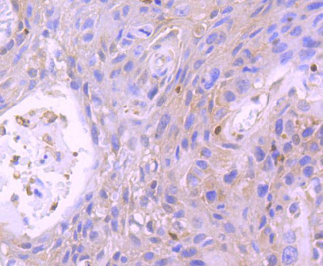 Immunohistochemical analysis of paraffin-embedded human breast carcinoma tissue using anti-STAT5b antibody. The section was pre-treated using heat mediated antigen retrieval with Tris-EDTA buffer (pH 9.0) for 20 minutes.The tissues were blocked in 1% BSA for 30 minutes at room temperature, washed with ddH2O and PBS, and then probed with the primary antibody (ET1612-63, 1/50) for 30 minutes at room temperature. The detection was performed using an HRP conjugated compact polymer system. DAB was used as the chromogen. Tissues were counterstained with hematoxylin and mounted with DPX.