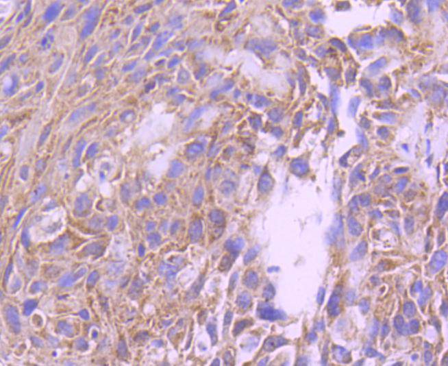 Immunohistochemical analysis of paraffin-embedded human breast carcinoma tissue using anti-FOXO4 antibody. The section was pre-treated using heat mediated antigen retrieval with Tris-EDTA buffer (pH 8.0-8.4) for 20 minutes.The tissues were blocked in 5% BSA for 30 minutes at room temperature, washed with ddH2O and PBS, and then probed with the primary antibody (ET1612-66, 1/50) for 30 minutes at room temperature. The detection was performed using an HRP conjugated compact polymer system. DAB was used as the chromogen. Tissues were counterstained with hematoxylin and mounted with DPX.
