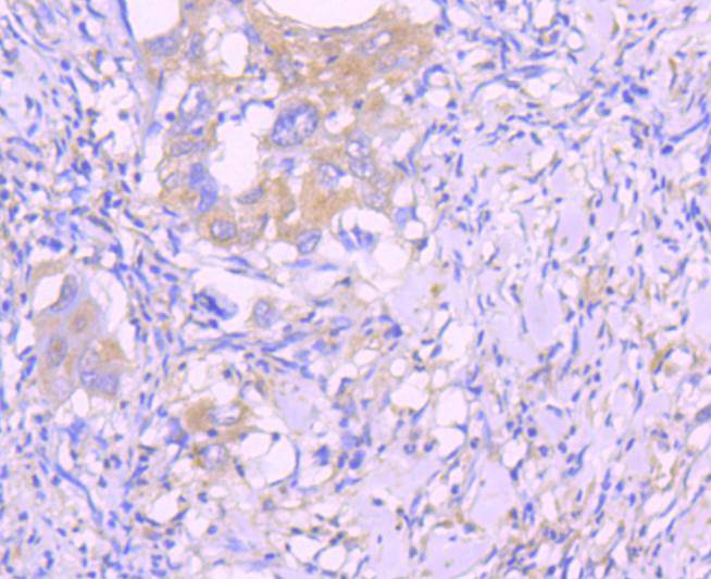Immunohistochemical analysis of paraffin-embedded human lung carcinoma tissue using anti-Caspase-8 antibody. The section was pre-treated using heat mediated antigen retrieval with Tris-EDTA buffer (pH 8.0-8.4) for 20 minutes.The tissues were blocked in 5% BSA for 30 minutes at room temperature, washed with ddH2O and PBS, and then probed with the primary antibody (ET1612-70, 1/50) for 30 minutes at room temperature. The detection was performed using an HRP conjugated compact polymer system. DAB was used as the chromogen. Tissues were counterstained with hematoxylin and mounted with DPX.