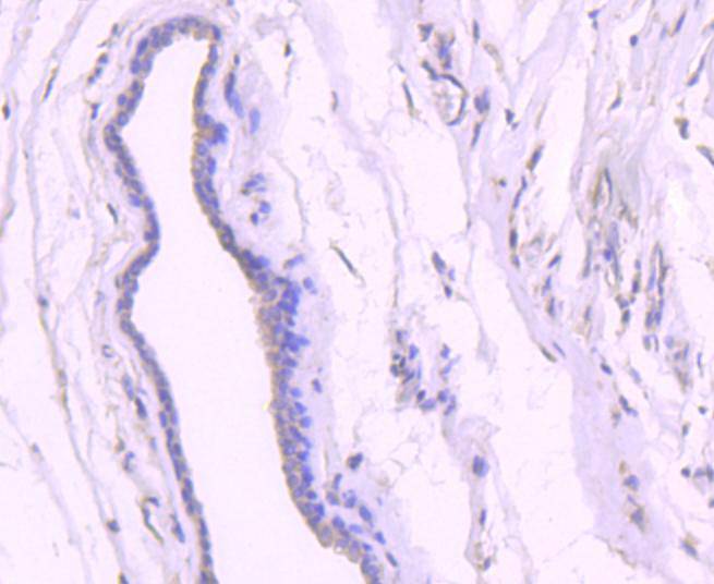 Immunohistochemical analysis of paraffin-embedded human breast carcinoma tissue using anti-p53 (acetyl K382) antibody. The section was pre-treated using heat mediated antigen retrieval with Tris-EDTA buffer (pH 8.0-8.4) for 20 minutes.The tissues were blocked in 5% BSA for 30 minutes at room temperature, washed with ddH2O and PBS, and then probed with the primary antibody (ET1612-71, 1/50) for 30 minutes at room temperature. The detection was performed using an HRP conjugated compact polymer system. DAB was used as the chromogen. Tissues were counterstained with hematoxylin and mounted with DPX.
