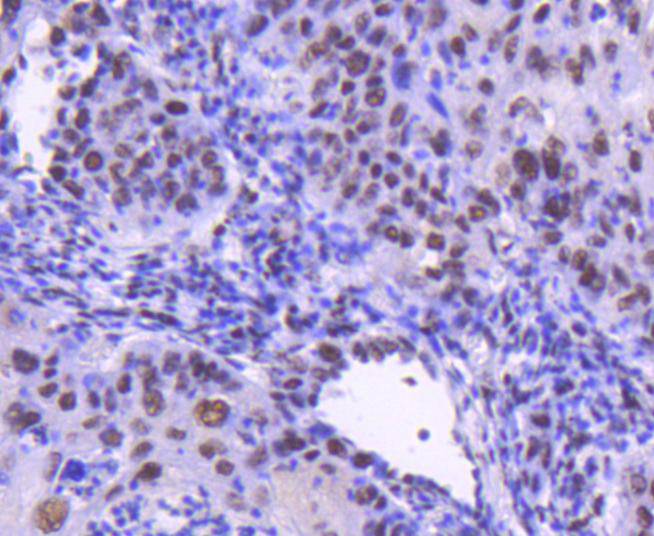 Immunohistochemical analysis of paraffin-embedded human lung carcinoma tissue using anti-Cdk9 antibody. The section was pre-treated using heat mediated antigen retrieval with Tris-EDTA buffer (pH 8.0-8.4) for 20 minutes.The tissues were blocked in 5% BSA for 30 minutes at room temperature, washed with ddH2O and PBS, and then probed with the primary antibody (ET1612-78, 1/50) for 30 minutes at room temperature. The detection was performed using an HRP conjugated compact polymer system. DAB was used as the chromogen. Tissues were counterstained with hematoxylin and mounted with DPX.