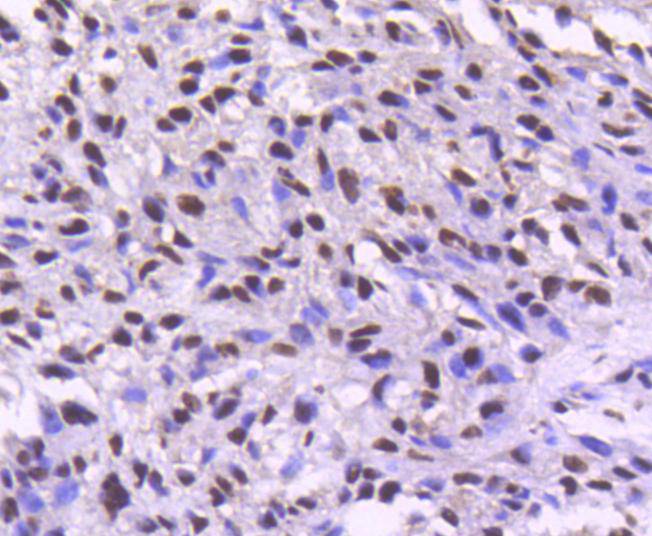 Immunohistochemical analysis of paraffin-embedded human breast carcinoma tissue using anti-Cdk9 antibody. The section was pre-treated using heat mediated antigen retrieval with Tris-EDTA buffer (pH 8.0-8.4) for 20 minutes.The tissues were blocked in 5% BSA for 30 minutes at room temperature, washed with ddH2O and PBS, and then probed with the primary antibody (ET1612-78, 1/50) for 30 minutes at room temperature. The detection was performed using an HRP conjugated compact polymer system. DAB was used as the chromogen. Tissues were counterstained with hematoxylin and mounted with DPX.