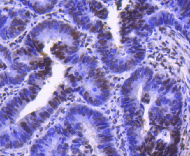 Immunohistochemical analysis of paraffin-embedded human colon carcinoma tissue using anti-Cdk9 antibody. The section was pre-treated using heat mediated antigen retrieval with Tris-EDTA buffer (pH 8.0-8.4) for 20 minutes.The tissues were blocked in 5% BSA for 30 minutes at room temperature, washed with ddH2O and PBS, and then probed with the primary antibody (ET1612-78, 1/50) for 30 minutes at room temperature. The detection was performed using an HRP conjugated compact polymer system. DAB was used as the chromogen. Tissues were counterstained with hematoxylin and mounted with DPX.