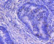 Immunohistochemical analysis of paraffin-embedded human colon carcinoma tissue using anti-Cyclin A1+ Cyclin A2 antibody. The section was pre-treated using heat mediated antigen retrieval with Tris-EDTA buffer (pH 8.0-8.4) for 20 minutes.The tissues were blocked in 5% BSA for 30 minutes at room temperature, washed with ddH2O and PBS, and then probed with the primary antibody (ET1612-8, 1/50) for 30 minutes at room temperature. The detection was performed using an HRP conjugated compact polymer system. DAB was used as the chromogen. Tissues were counterstained with hematoxylin and mounted with DPX.