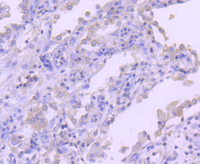 Immunohistochemical analysis of paraffin-embedded human lung carcinoma tissue using anti-RON antibody. The section was pre-treated using heat mediated antigen retrieval with Tris-EDTA buffer (pH 8.0-8.4) for 20 minutes.The tissues were blocked in 5% BSA for 30 minutes at room temperature, washed with ddH2O and PBS, and then probed with the primary antibody (ET1612-80, 1/50) for 30 minutes at room temperature. The detection was performed using an HRP conjugated compact polymer system. DAB was used as the chromogen. Tissues were counterstained with hematoxylin and mounted with DPX.
