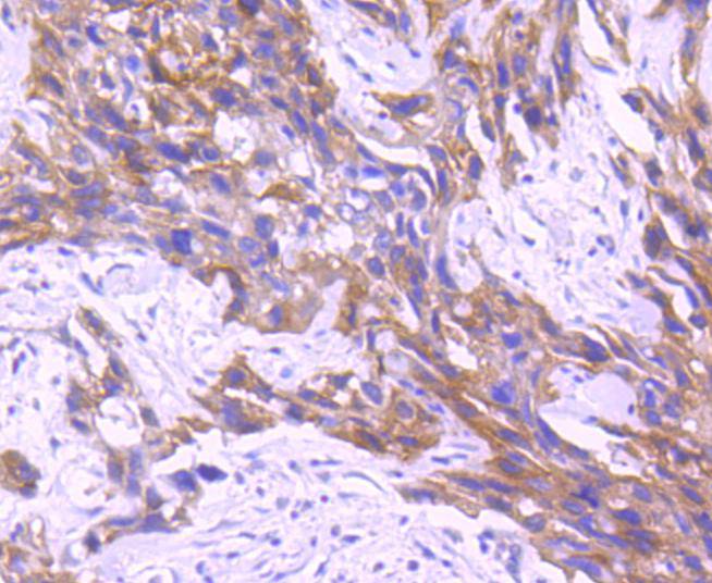 Immunohistochemical analysis of paraffin-embedded human breast carcinoma tissue using anti-RON antibody. The section was pre-treated using heat mediated antigen retrieval with Tris-EDTA buffer (pH 8.0-8.4) for 20 minutes.The tissues were blocked in 5% BSA for 30 minutes at room temperature, washed with ddH2O and PBS, and then probed with the primary antibody (ET1612-80, 1/50) for 30 minutes at room temperature. The detection was performed using an HRP conjugated compact polymer system. DAB was used as the chromogen. Tissues were counterstained with hematoxylin and mounted with DPX.