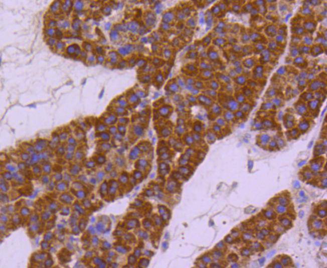 Immunohistochemical analysis of paraffin-embedded human liver carcinoma tissue using anti-HSPA4 antibody. The section was pre-treated using heat mediated antigen retrieval with Tris-EDTA buffer (pH 8.0-8.4) for 20 minutes.The tissues were blocked in 5% BSA for 30 minutes at room temperature, washed with ddH2O and PBS, and then probed with the primary antibody (ET1612-83, 1/50) for 30 minutes at room temperature. The detection was performed using an HRP conjugated compact polymer system. DAB was used as the chromogen. Tissues were counterstained with hematoxylin and mounted with DPX.