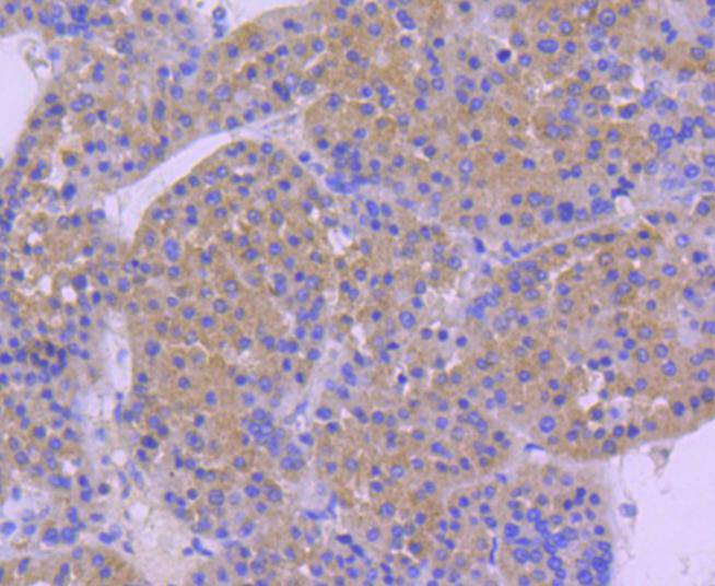 Immunohistochemical analysis of paraffin-embedded human liver carcinoma tissue using anti-Hsp105 antibody. The section was pre-treated using heat mediated antigen retrieval with Tris-EDTA buffer (pH 9.0) for 20 minutes.The tissues were blocked in 1% BSA for 30 minutes at room temperature, washed with ddH2O and PBS, and then probed with the primary antibody (ET1612-88, 1/50) for 30 minutes at room temperature. The detection was performed using an HRP conjugated compact polymer system. DAB was used as the chromogen. Tissues were counterstained with hematoxylin and mounted with DPX.