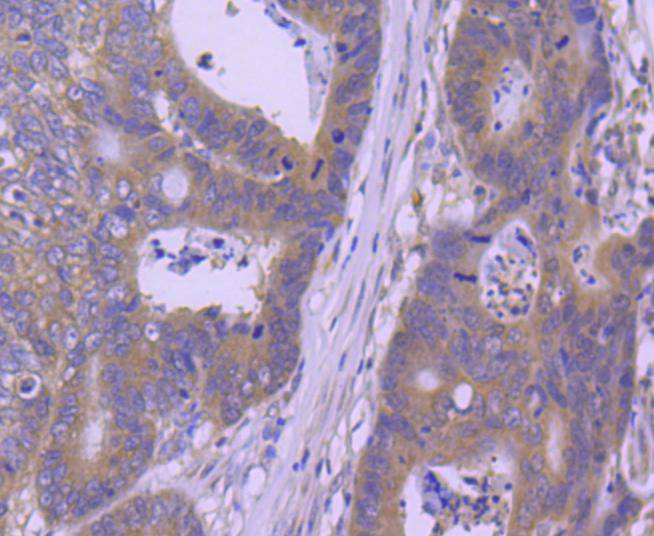 Immunohistochemical analysis of paraffin-embedded human colon carcinoma tissue using anti-Hsp105 antibody. The section was pre-treated using heat mediated antigen retrieval with Tris-EDTA buffer (pH 9.0) for 20 minutes.The tissues were blocked in 1% BSA for 30 minutes at room temperature, washed with ddH2O and PBS, and then probed with the primary antibody (ET1612-88, 1/50) for 30 minutes at room temperature. The detection was performed using an HRP conjugated compact polymer system. DAB was used as the chromogen. Tissues were counterstained with hematoxylin and mounted with DPX.