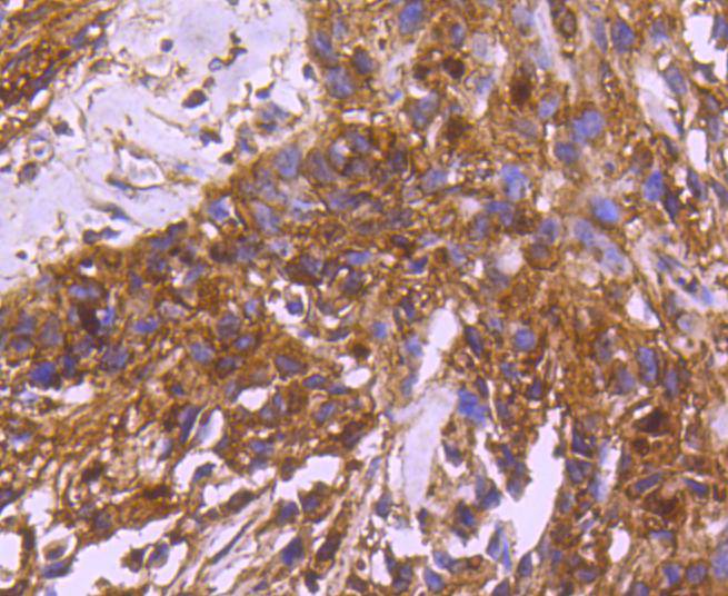 Immunohistochemical analysis of paraffin-embedded human breast carcinoma tissue using anti-14-3-3 alpha+beta antibody. The section was pre-treated using heat mediated antigen retrieval with Tris-EDTA buffer (pH 8.0-8.4) for 20 minutes.The tissues were blocked in 5% BSA for 30 minutes at room temperature, washed with ddH2O and PBS, and then probed with the primary antibody (ET1612-99, 1/50) for 30 minutes at room temperature. The detection was performed using an HRP conjugated compact polymer system. DAB was used as the chromogen. Tissues were counterstained with hematoxylin and mounted with DPX.