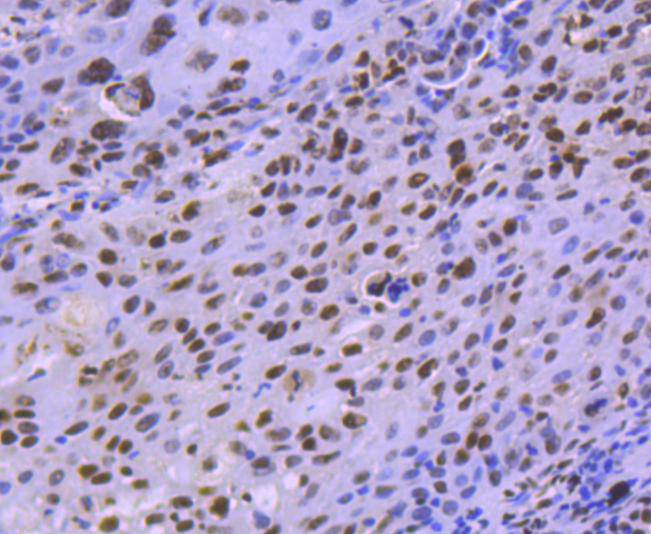 Immunohistochemical analysis of paraffin-embedded human lung carcinoma tissue using anti-HDAC8 antibody. The section was pre-treated using heat mediated antigen retrieval with Tris-EDTA buffer (pH 8.0-8.4) for 20 minutes.The tissues were blocked in 5% BSA for 30 minutes at room temperature, washed with ddH2O and PBS, and then probed with the primary antibody (ET1701-12, 1/50) for 30 minutes at room temperature. The detection was performed using an HRP conjugated compact polymer system. DAB was used as the chromogen. Tissues were counterstained with hematoxylin and mounted with DPX.