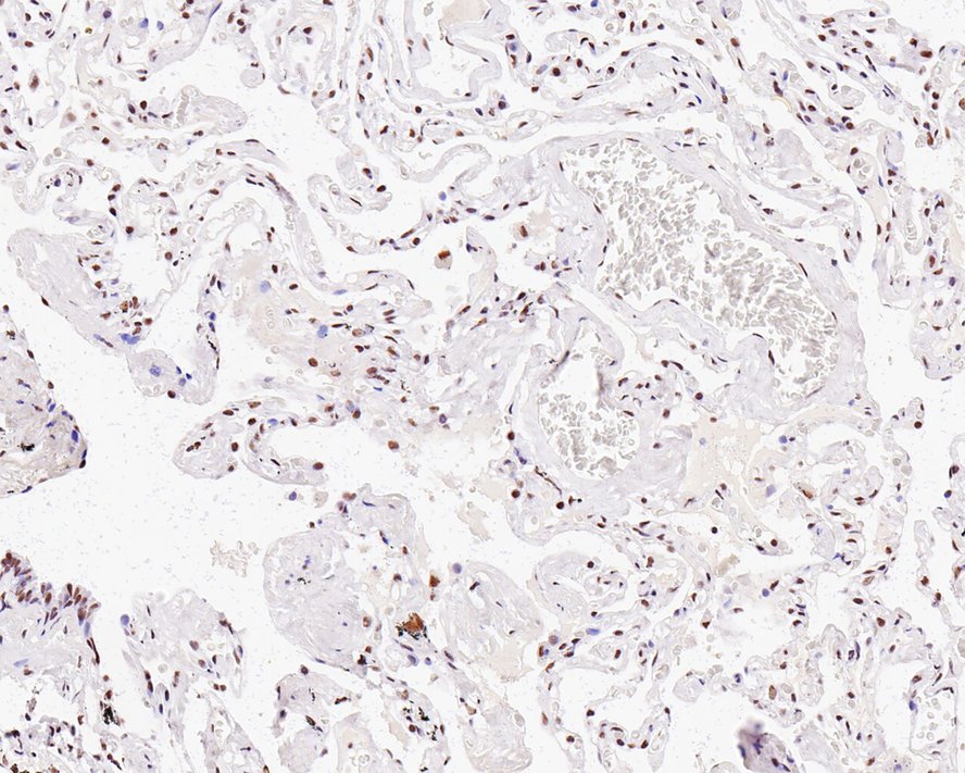 Immunohistochemical analysis of paraffin-embedded human lung tissue with Rabbit anti-HDAC8 antibody (ET1701-12) at 1/200 dilution.<br />
<br />
The section was pre-treated using heat mediated antigen retrieval with sodium citrate buffer (pH 6.0) for 2 minutes. The tissues were blocked in 1% BSA for 20 minutes at room temperature, washed with ddH2O and PBS, and then probed with the primary antibody (ET1701-12) at 1/200 dilution for 1 hour at room temperature. The detection was performed using an HRP conjugated compact polymer system. DAB was used as the chromogen. Tissues were counterstained with hematoxylin and mounted with DPX.