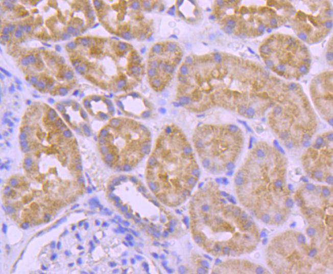 Immunohistochemical analysis of paraffin-embedded human breast carcinoma tissue using anti-A-RAF antibody. The section was pre-treated using heat mediated antigen retrieval with Tris-EDTA buffer (pH 8.0-8.4) for 20 minutes.The tissues were blocked in 5% BSA for 30 minutes at room temperature, washed with ddH2O and PBS, and then probed with the primary antibody (ET1701-18, 1/50) for 30 minutes at room temperature. The detection was performed using an HRP conjugated compact polymer system. DAB was used as the chromogen. Tissues were counterstained with hematoxylin and mounted with DPX.
