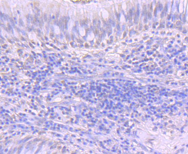 Immunohistochemical analysis of paraffin-embedded human breast carcinoma tissue using anti-ATF1 antibody. Counter stained with hematoxylin.