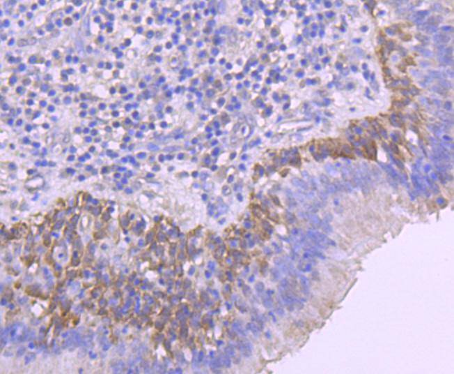 Immunohistochemical analysis of paraffin-embedded human lung carcinoma tissue using anti-Phospho-Rac1+Cdc42(Ser71) antibody. The section was pre-treated using heat mediated antigen retrieval with Tris-EDTA buffer (pH 8.0-8.4) for 20 minutes.The tissues were blocked in 5% BSA for 30 minutes at room temperature, washed with ddH2O and PBS, and then probed with the primary antibody (ET1701-40, 1/50) for 30 minutes at room temperature. The detection was performed using an HRP conjugated compact polymer system. DAB was used as the chromogen. Tissues were counterstained with hematoxylin and mounted with DPX.