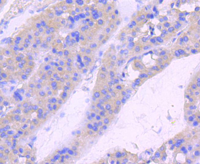 Immunohistochemical analysis of paraffin-embedded human liver carcinoma tissue using anti-Phospho-Rac1+Cdc42(Ser71) antibody. The section was pre-treated using heat mediated antigen retrieval with Tris-EDTA buffer (pH 8.0-8.4) for 20 minutes.The tissues were blocked in 5% BSA for 30 minutes at room temperature, washed with ddH2O and PBS, and then probed with the primary antibody (ET1701-40, 1/50) for 30 minutes at room temperature. The detection was performed using an HRP conjugated compact polymer system. DAB was used as the chromogen. Tissues were counterstained with hematoxylin and mounted with DPX.