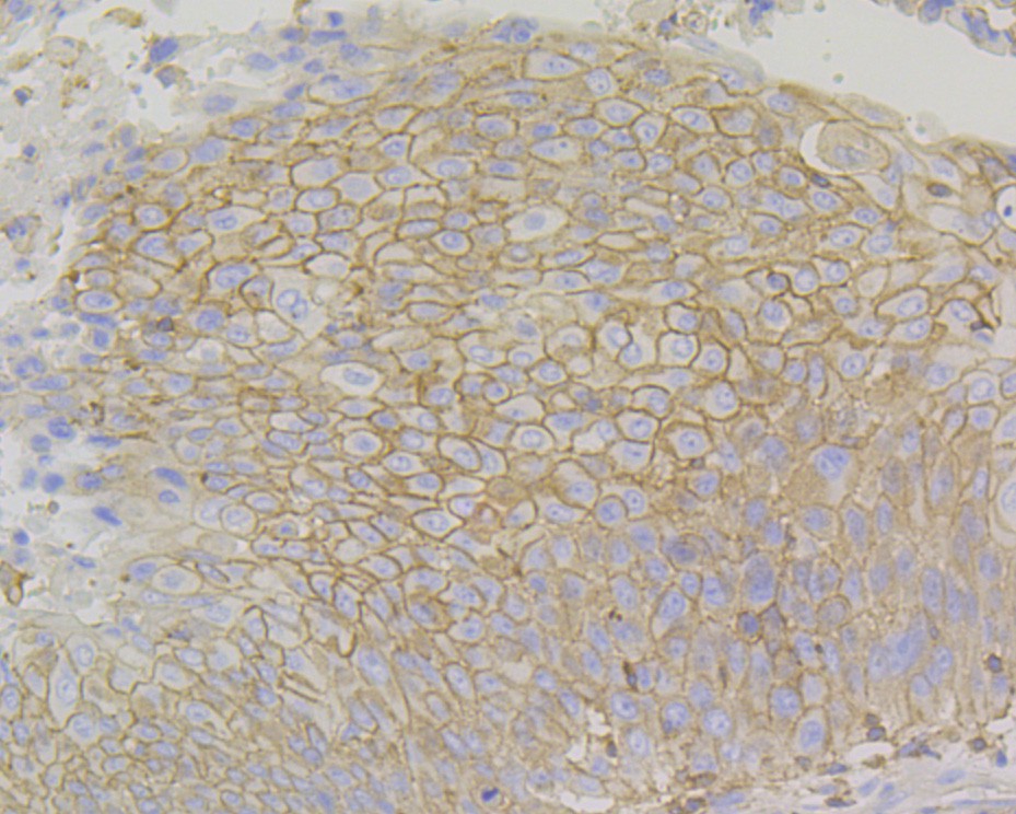Immunohistochemical analysis of paraffin-embedded human non-small cell lung cancer tissue using anti-PD-L1 antibody. The section was pre-treated using heat mediated antigen retrieval with Tris-EDTA buffer (pH 8.0-8.4) for 20 minutes.The tissues were blocked in 5% BSA for 30 minutes at room temperature, washed with ddH2O and PBS, and then probed with the primary antibody (ET1701-41, 1/200) for 30 minutes at room temperature. The detection was performed using an HRP conjugated compact polymer system. DAB was used as the chromogen. Tissues were counterstained with hematoxylin and mounted with DPX.