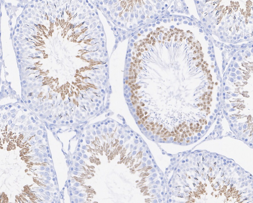 Immunohistochemical analysis of paraffin-embedded human colon carcinoma tissue with Rabbit anti-STAT4 antibody (ET1701-42) at 1/400 dilution.<br />
<br />
The section was pre-treated using heat mediated antigen retrieval with sodium citrate buffer (pH 6.0) for 2 minutes. The tissues were blocked in 1% BSA for 20 minutes at room temperature, washed with ddH2O and PBS, and then probed with the primary antibody (ET1701-42) at 1/400 dilution for 1 hour at room temperature. The detection was performed using an HRP conjugated compact polymer system. DAB was used as the chromogen. Tissues were counterstained with hematoxylin and mounted with DPX.