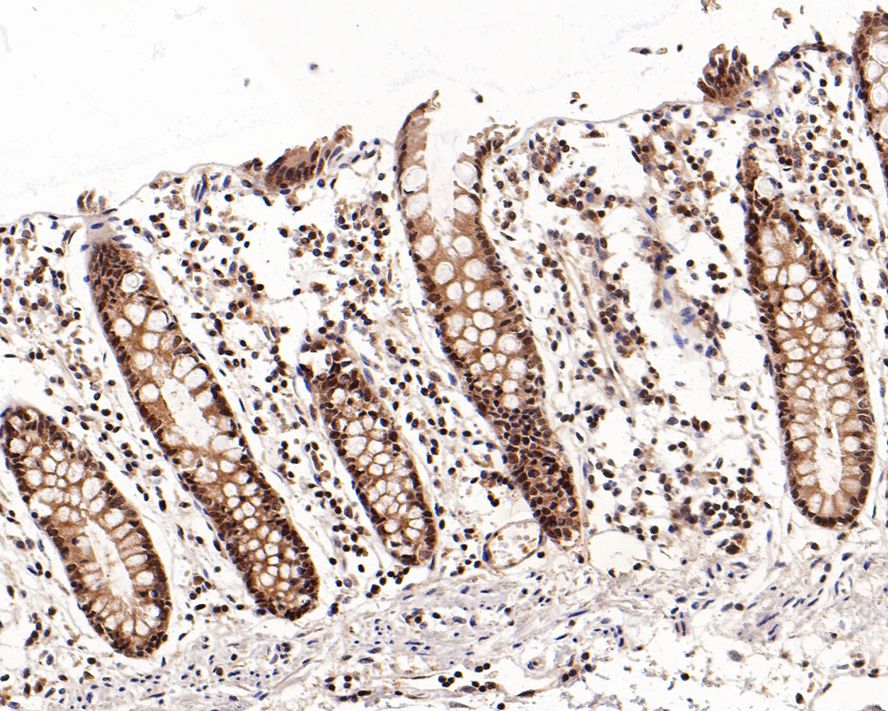 Immunohistochemical analysis of paraffin-embedded human colon tissue with Mouse anti-MEK3+MEK6 antibody (ET1701-48) at 1/200 dilution.<br />
<br />
The section was pre-treated using heat mediated antigen retrieval with sodium citrate buffer (pH 6.0) for 2 minutes. The tissues were blocked in 1% BSA for 20 minutes at room temperature, washed with ddH2O and PBS, and then probed with the primary antibody (ET1701-48) at 1/200 dilution for 1 hour at room temperature. The detection was performed using an HRP conjugated compact polymer system. DAB was used as the chromogen. Tissues were counterstained with hematoxylin and mounted with DPX.
