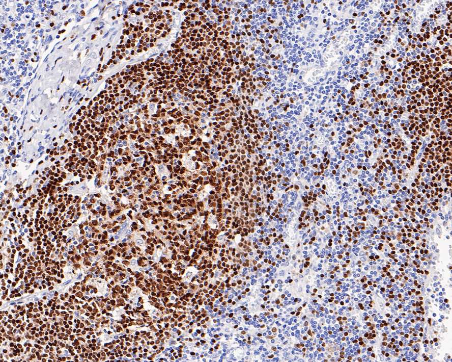 Immunohistochemical analysis of paraffin-embedded human tonsil tissue with Rabbit anti-PAX5 antibody (ET1701-49) at 1/50 dilution.<br />
<br />
The section was pre-treated using heat mediated antigen retrieval with sodium citrate buffer (pH 6.0) for 2 minutes. The tissues were blocked in 1% BSA for 20 minutes at room temperature, washed with ddH2O and PBS, and then probed with the primary antibody (ET1701-49) at 1/50 dilution for 1 hour at room temperature. The detection was performed using an HRP conjugated compact polymer system. DAB was used as the chromogen. Tissues were counterstained with hematoxylin and mounted with DPX.