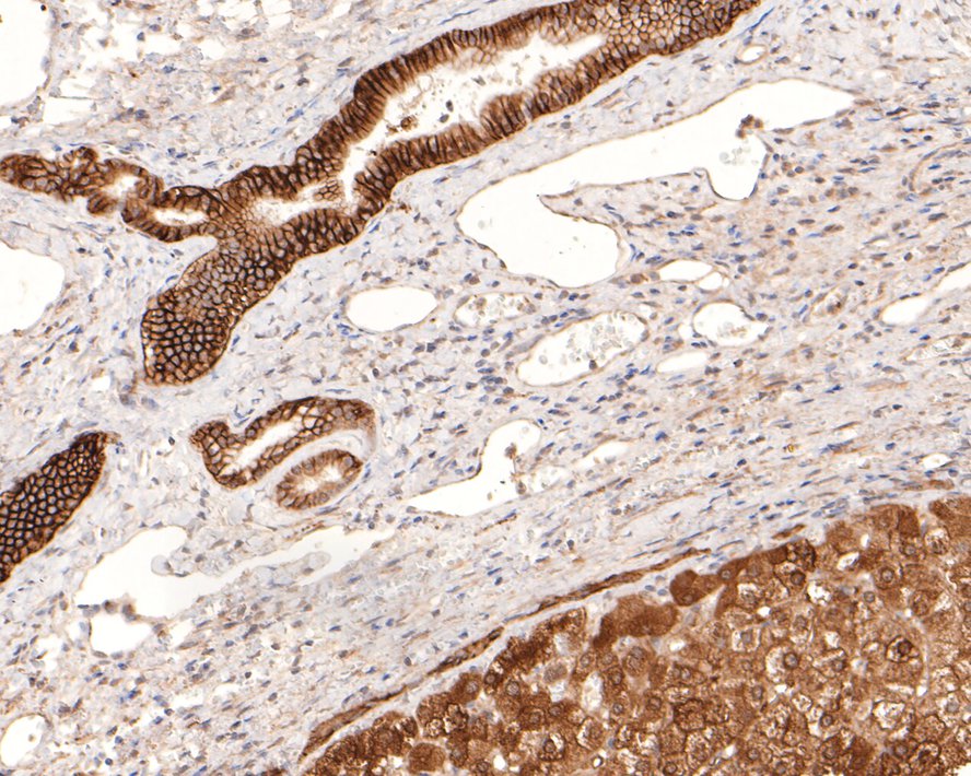 Immunohistochemical analysis of paraffin-embedded human liver tissue with Rabbit anti-Carbonic anhydrase 9 antibody (ET1701-51) at 1/200 dilution.<br />
<br />
The section was pre-treated using heat mediated antigen retrieval with sodium citrate buffer (pH 6.0) for 2 minutes. The tissues were blocked in 1% BSA for 20 minutes at room temperature, washed with ddH2O and PBS, and then probed with the primary antibody (ET1701-51) at 1/200 dilution for 1 hour at room temperature. The detection was performed using an HRP conjugated compact polymer system. DAB was used as the chromogen. Tissues were counterstained with hematoxylin and mounted with DPX.