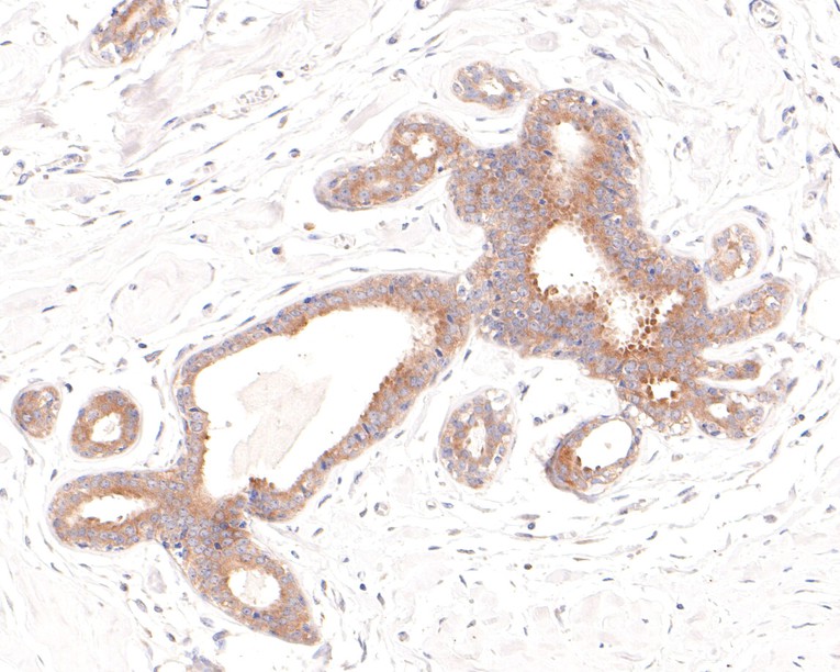 Immunohistochemical analysis of paraffin-embedded human breast tissue with Rabbit anti-HDAC6 antibody (ET1701-66) at 1/100 dilution.<br />
<br />
The section was pre-treated using heat mediated antigen retrieval with Tris-EDTA buffer (pH 9.0) for 20 minutes. The tissues were blocked in 1% BSA for 20 minutes at room temperature, washed with ddH2O and PBS, and then probed with the primary antibody (ET1701-66) at 1/100 dilution for 1 hour at room temperature. The detection was performed using an HRP conjugated compact polymer system. DAB was used as the chromogen. Tissues were counterstained with hematoxylin and mounted with DPX.